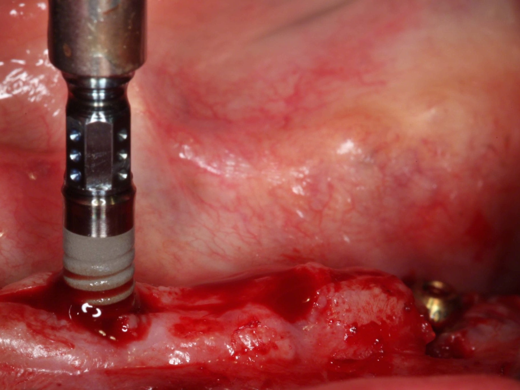 Abb 18 Insertion eines NNC Implantat