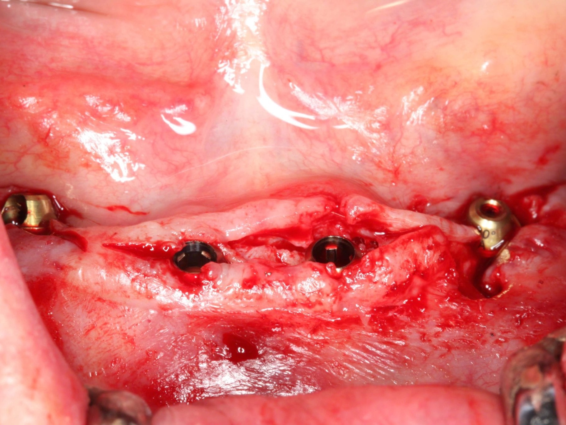 Abb 19 NNC-Implantate in Endposition