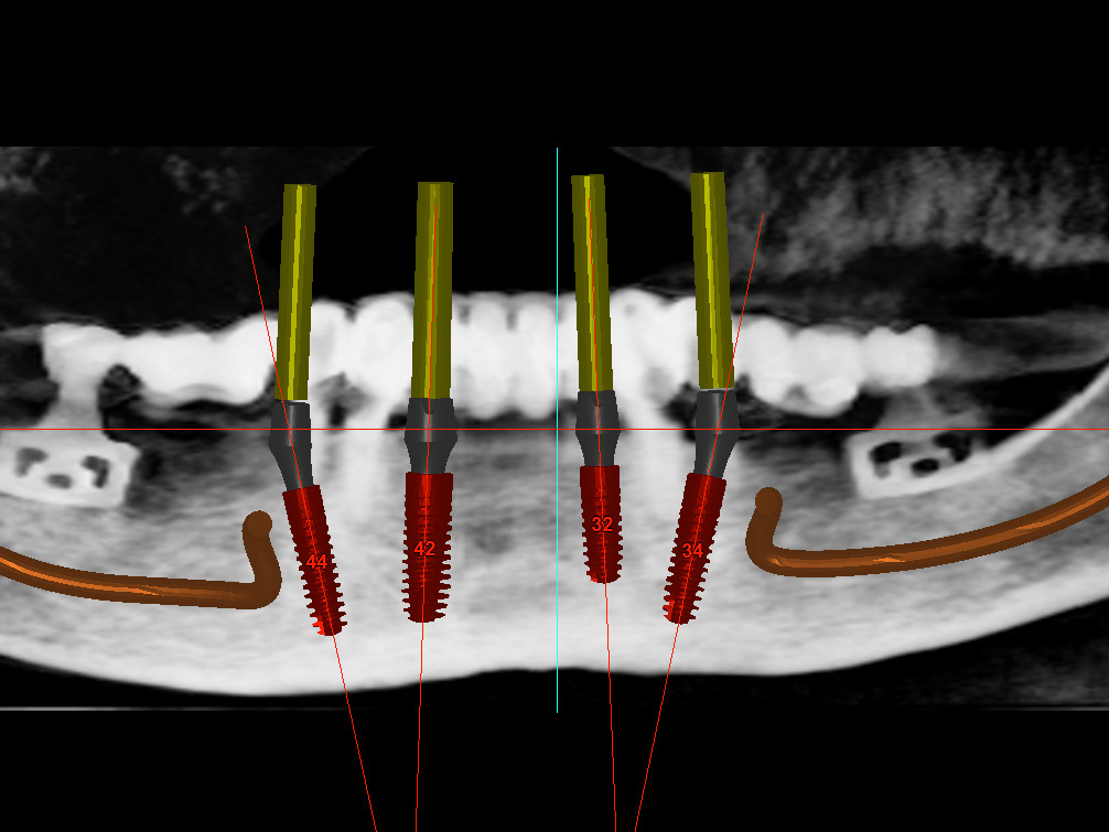 Abb 2 3D-planung mittels SimPlant®