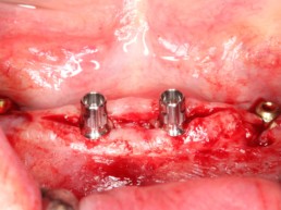 Abb 20 NNC-Implantate mit den entsprechenden Klebebasen