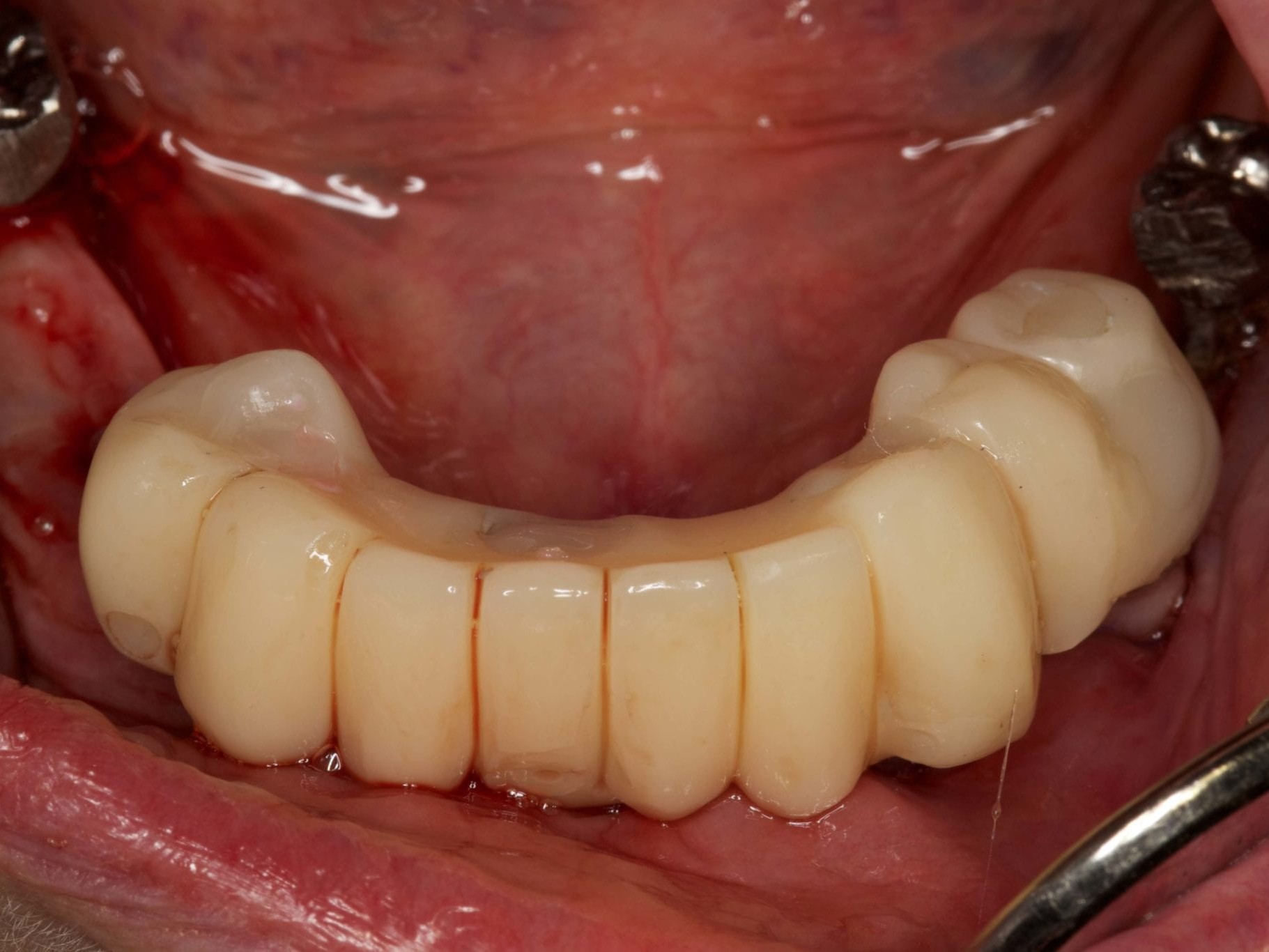 Abb 20 Sofortprovisorium in okklusaler Ansicht