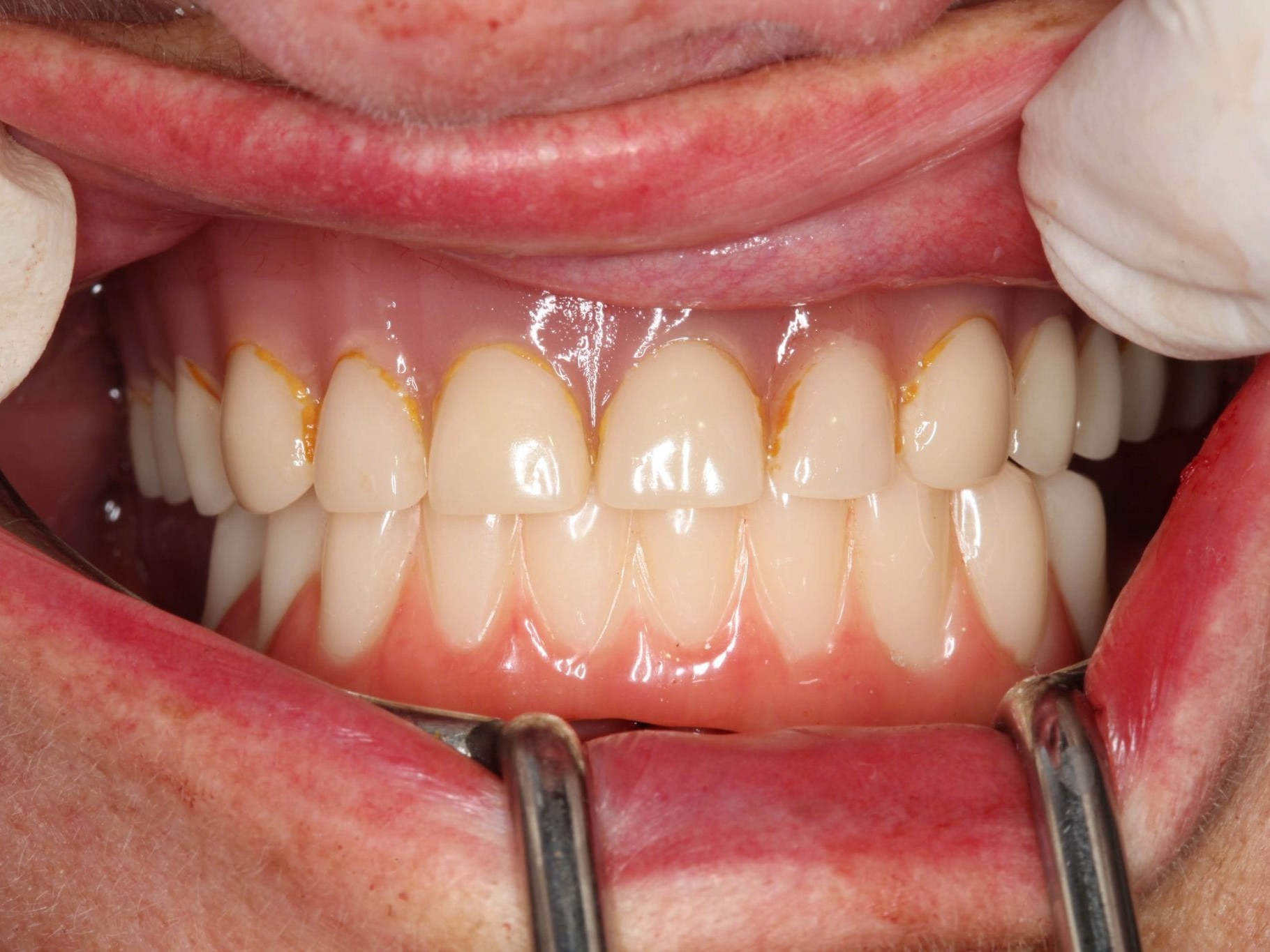 Abb 22 Eingliederung des Interimszahnersatzes in Okklusion