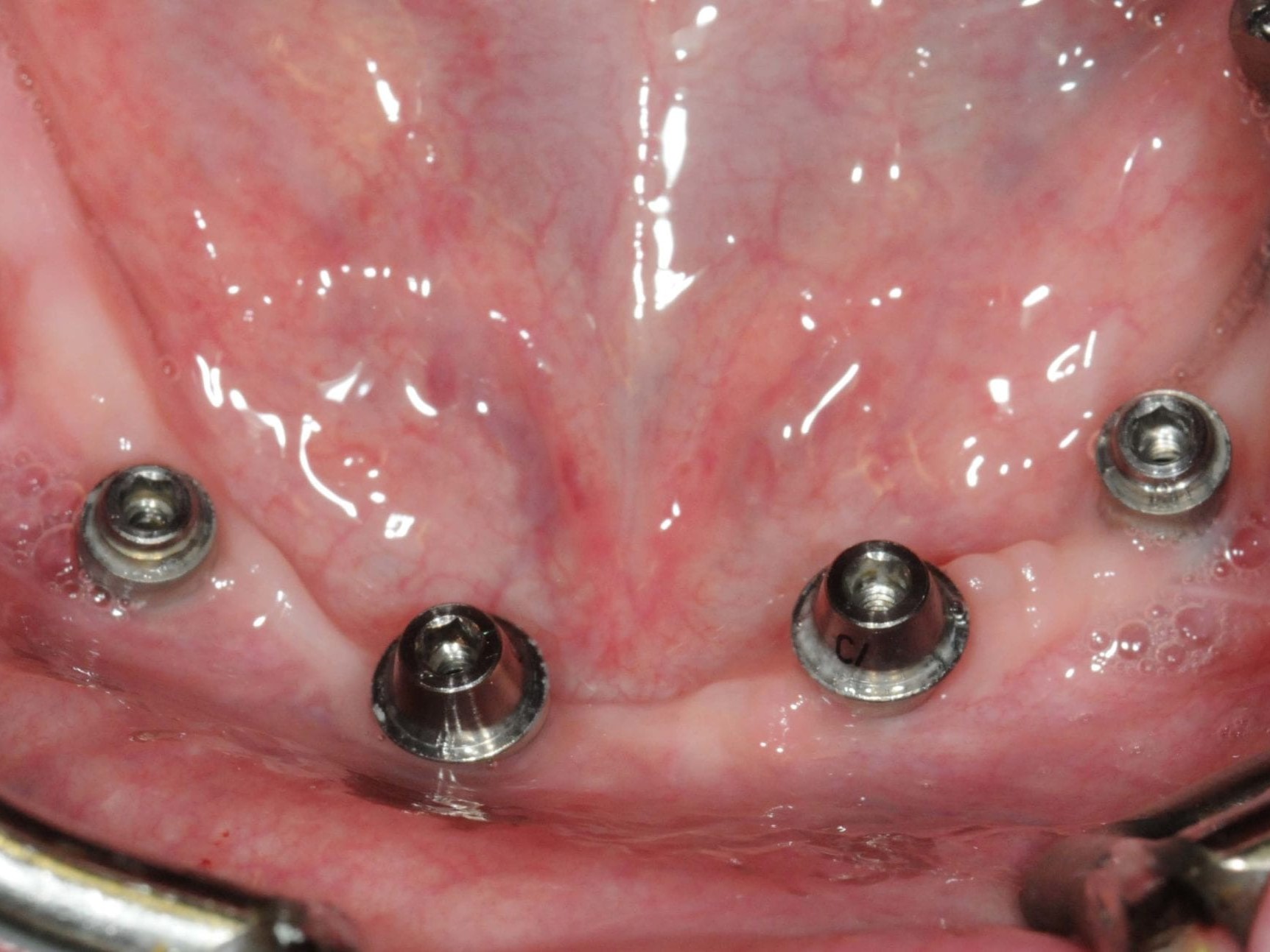 Abb 22 Situation 4 Monate postoperativ und vor Abformung