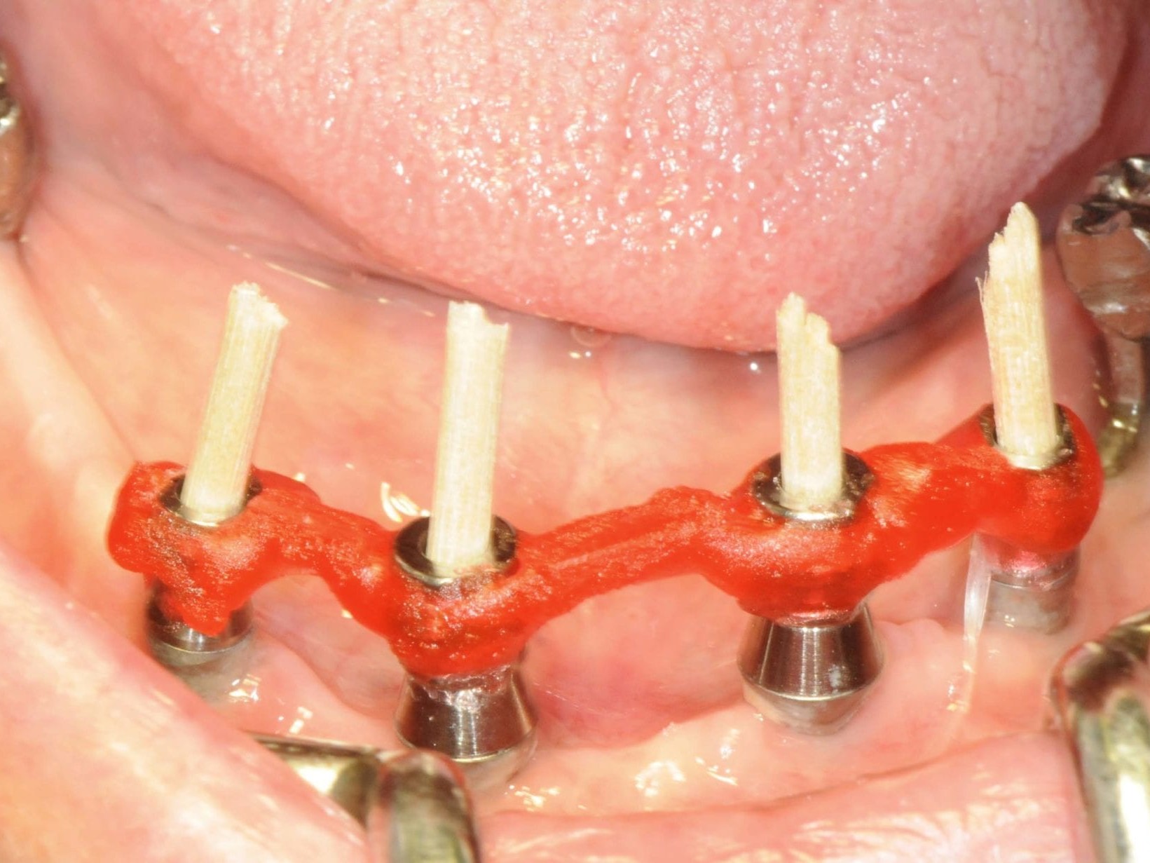 Abb 23 Verblockte Retentionskappen mit PATTERN RESIN™ vor Abformung