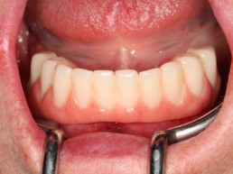 Abb 24 Zahnersatz in Mundhöhle refixiert