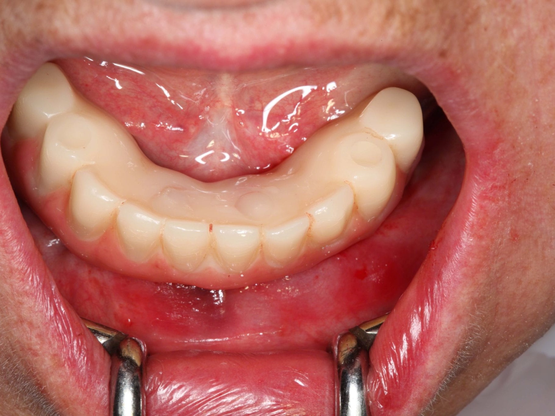 Abb 25 Schraubenkanäle mit Kunststoff verschlossen