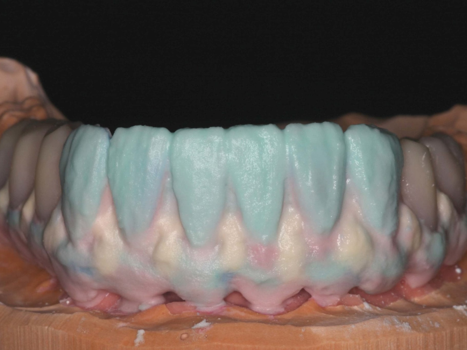 Abb 25 individuelle Verblendung der Frontzähne und der Zahnfleischanteile