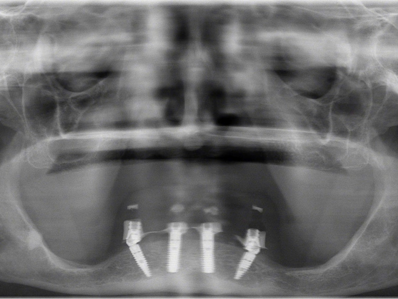 Abb 26 Postoperatives Orthopantomogramm