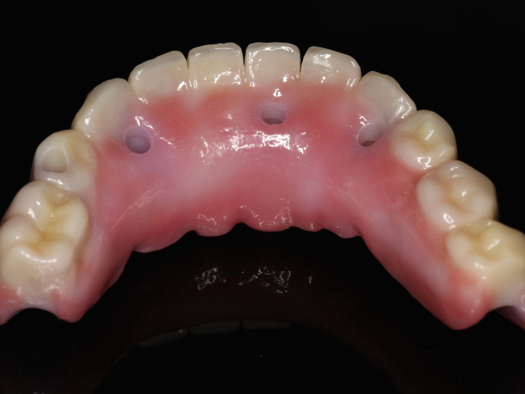 Abb 28 Impressionen der fertigen Arbeit von lingual