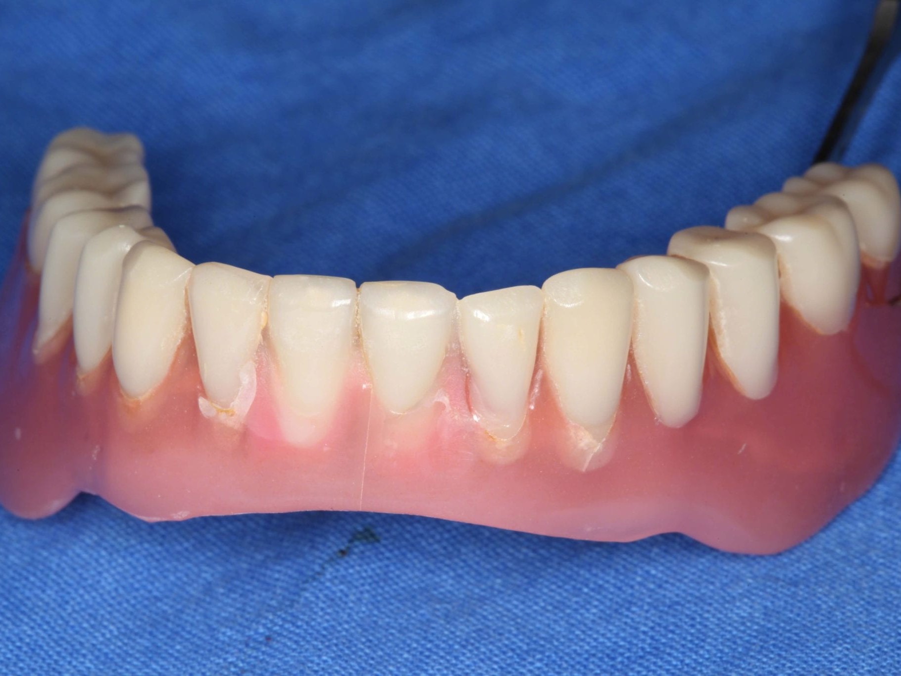 Abb 3 Unterkieferprothese von vestibulär