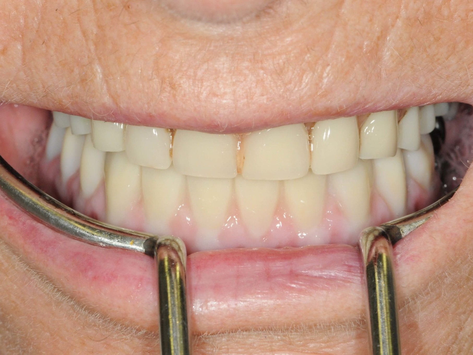 Abb 30 Impressionen der fertigen Arbeit in Okklusion