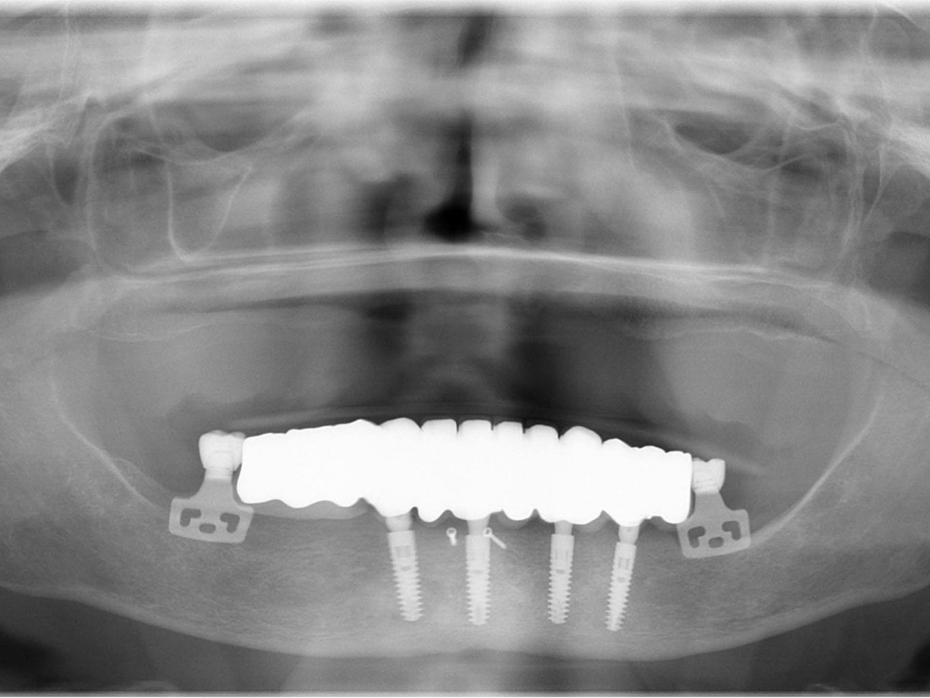 Abb 31 OPG 6 Wochen nach Behandlungsende