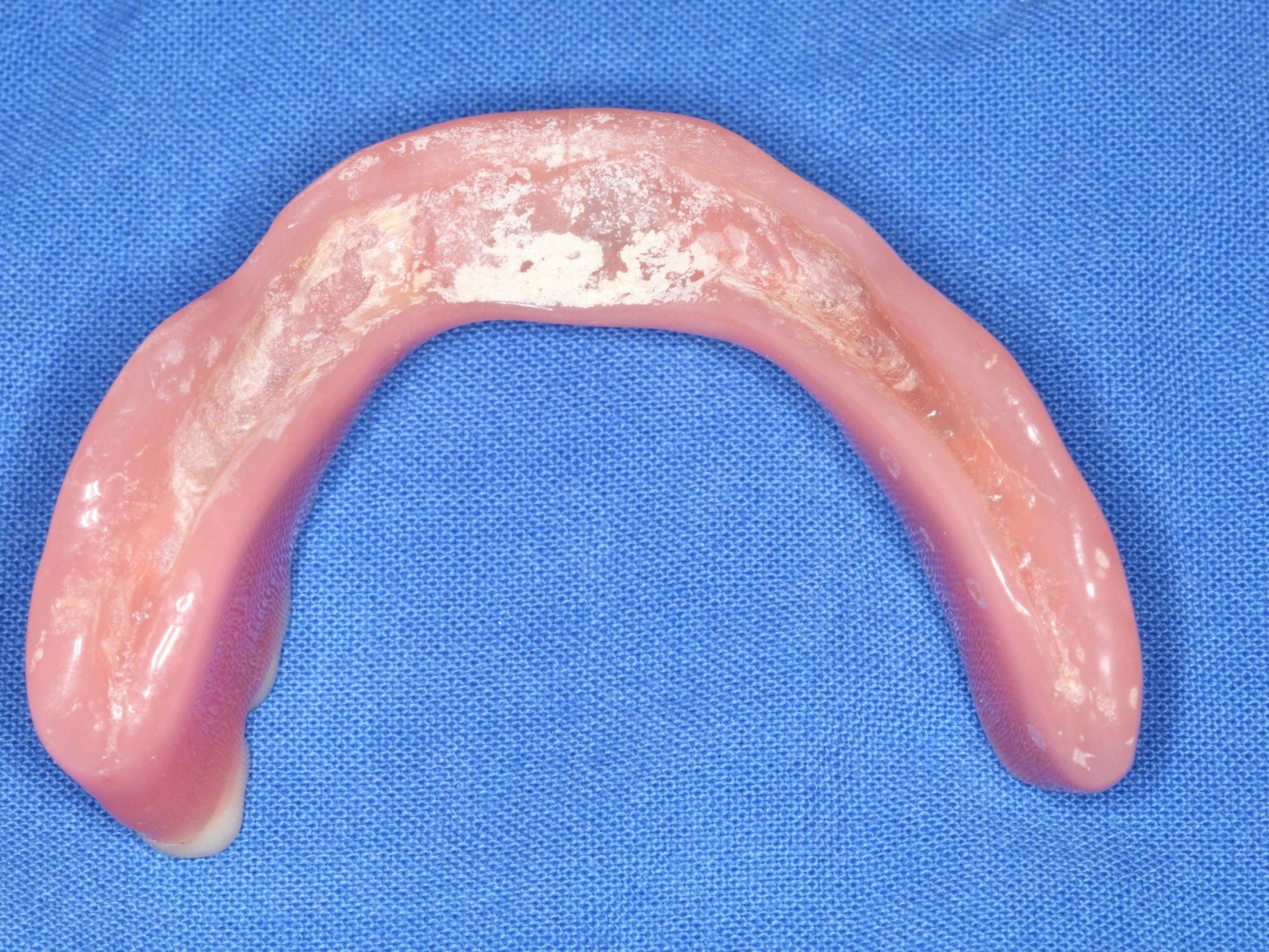 Abb. 4: Unterkieferprothese von basal