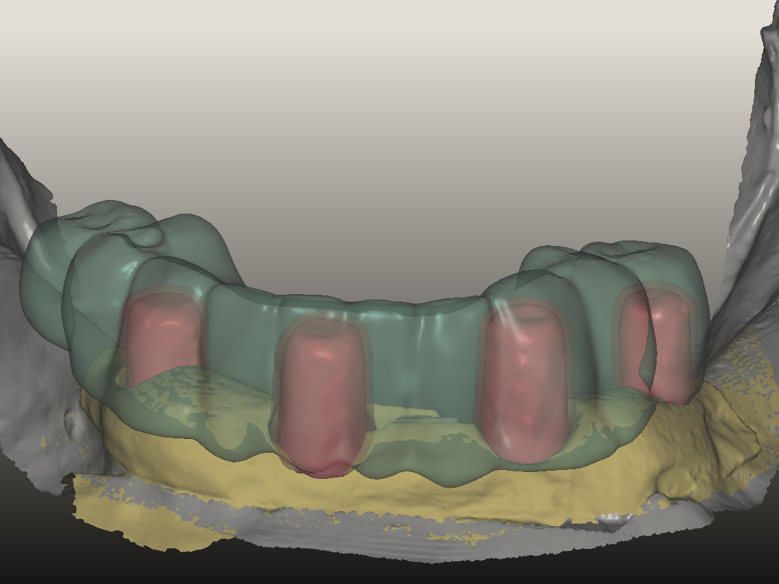Abb 5 Design des Sofortprovisoriums im CAD-Programm
