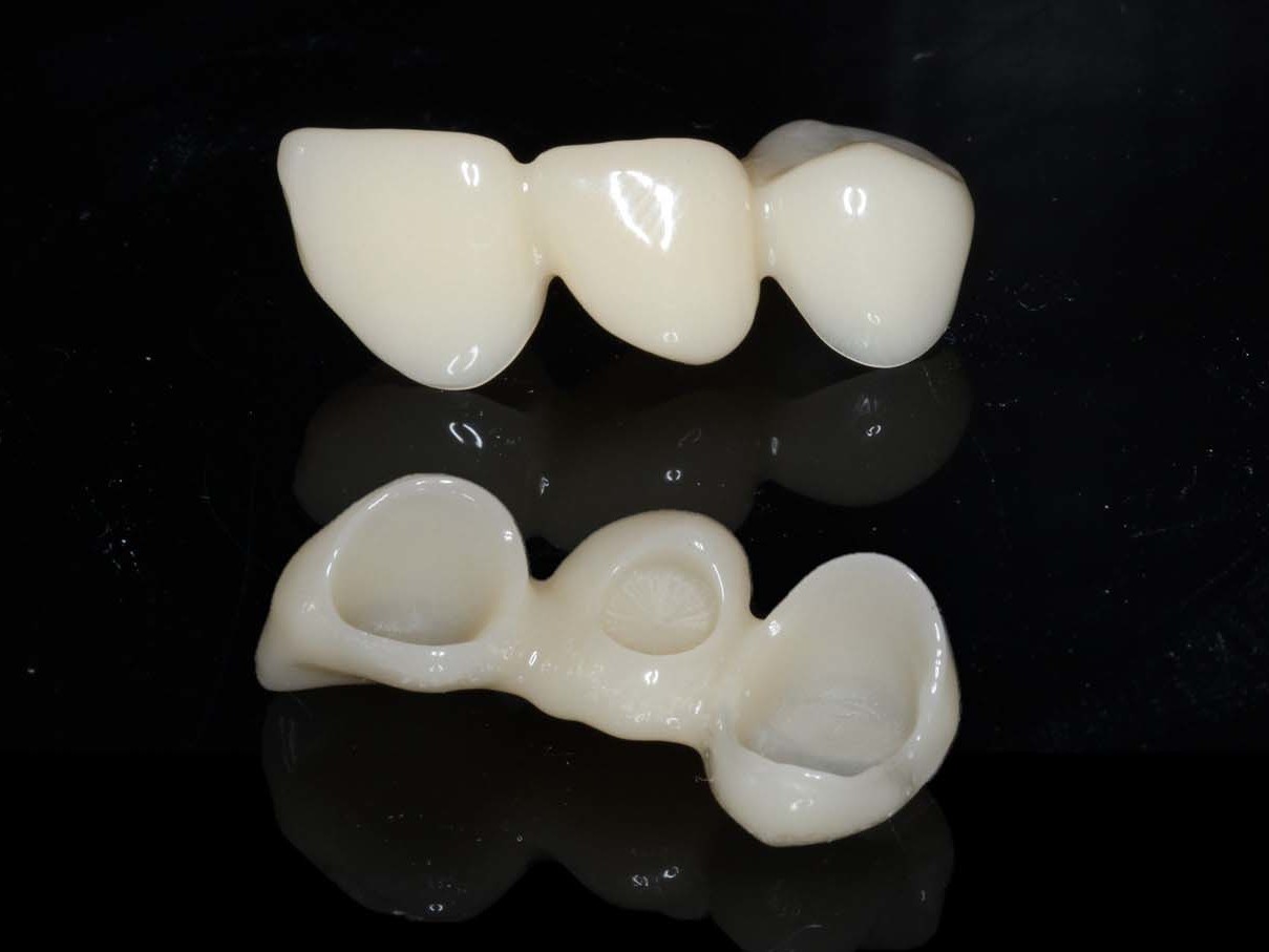Abb 5 PMMA-Provisorium von vestibulär und basal