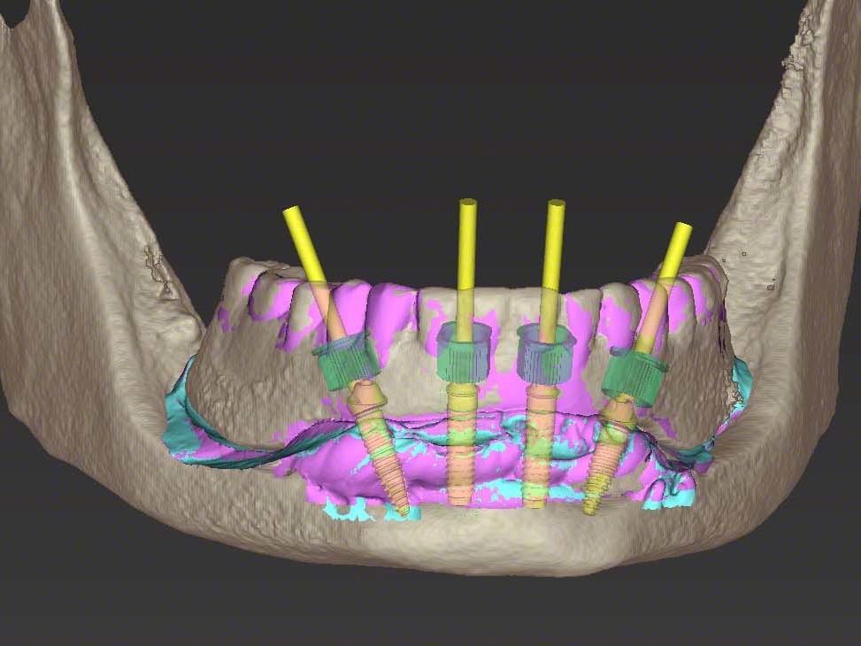 Abb 6 Visualisierung zweier NNC Variobase™-Klebeabutments regio 32 und 42 sowie der distalen Implantatpositionen 35 und 45 mit 30° verschraubten Sekundärteilen