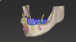 Abb 6a 3D-Planung mit Schablone und Bohrhülsen - Implantatachsen zueinander