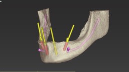 Abb. 6b: 3D-Planung ohne Schablone und Bohrhülsen - Darstellung des zu reduzierenden Knochenvolumens