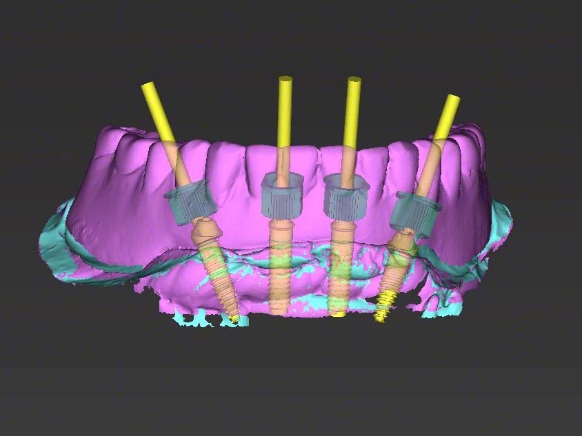 Abb 7 Visualisierung der Scanprothese