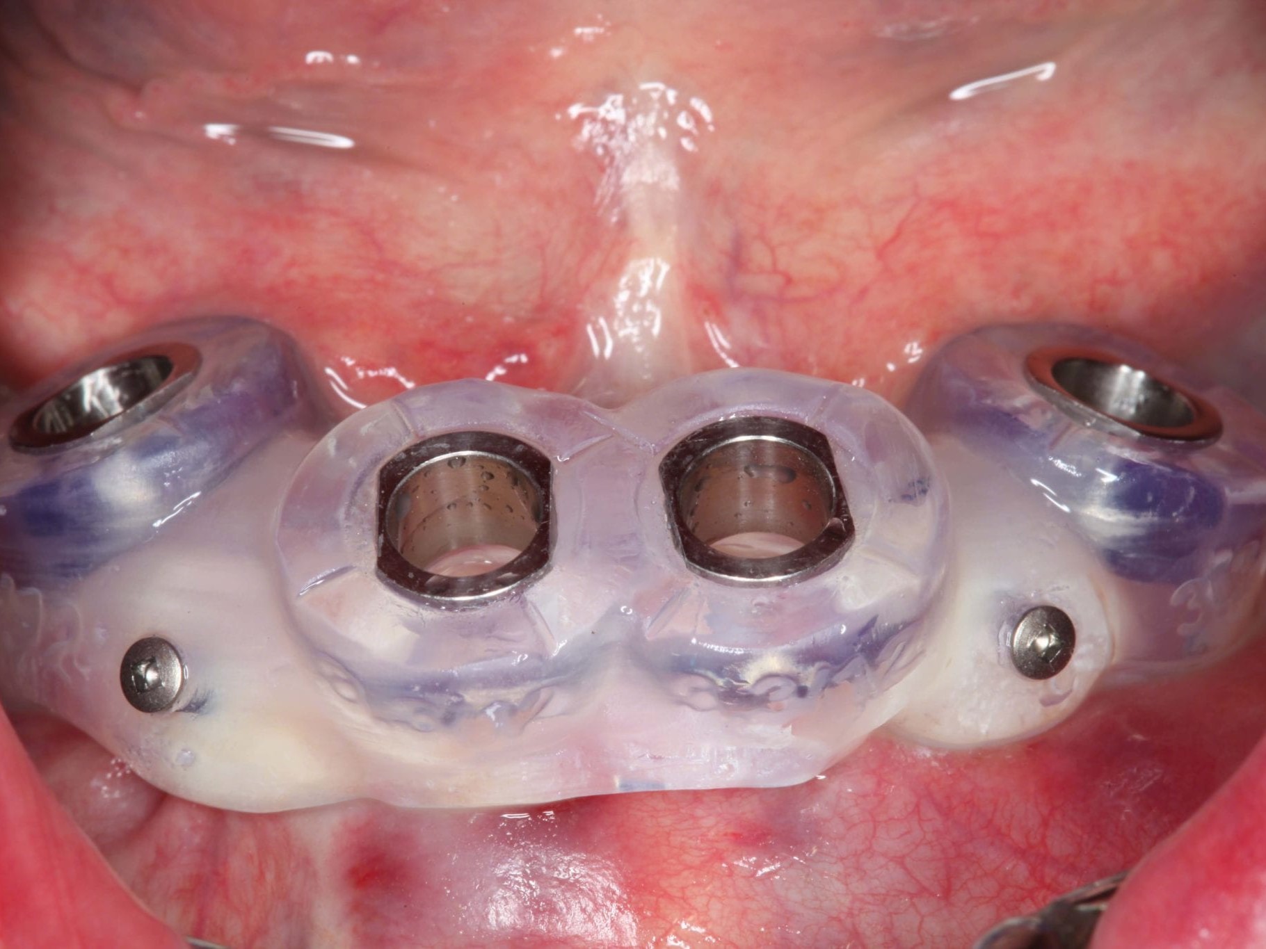 Abb 8 Bohrschablone eingesetzt mit Osteosyntheseschrauben fixiert