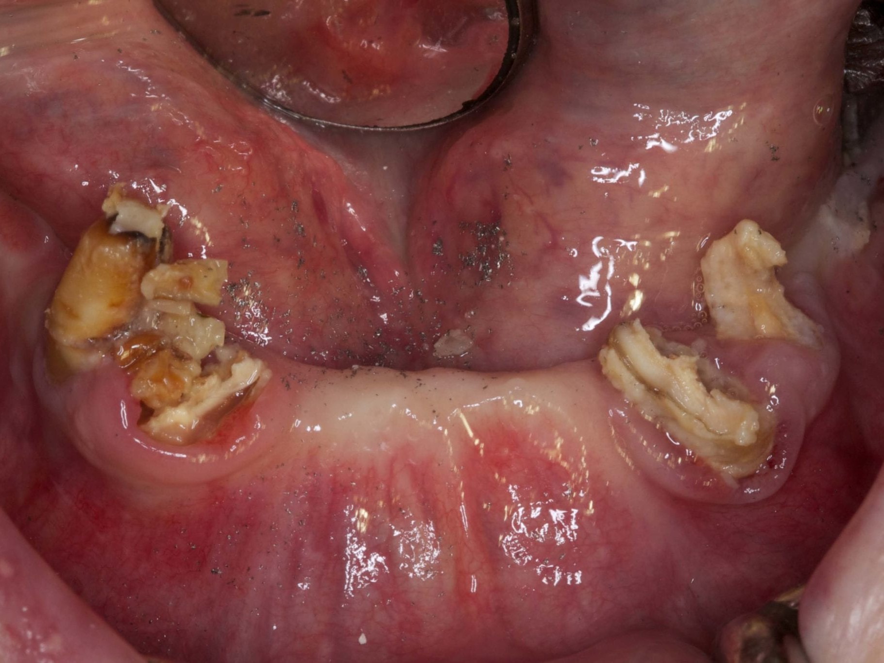 Abb 8 Klinische Situation nach Entfernung des Zahnersatzes