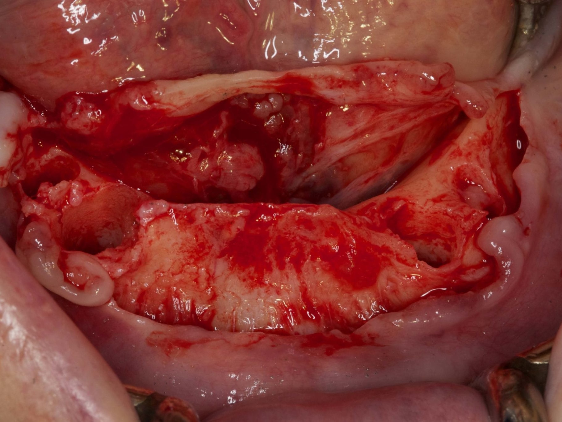 Abb 9 Situs nach operativer Vorbereitung