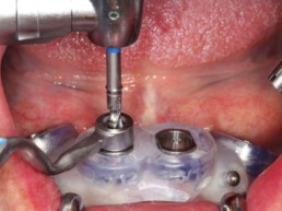 Abb 9 initiale Aufbereitung der axialen Implantatstollen