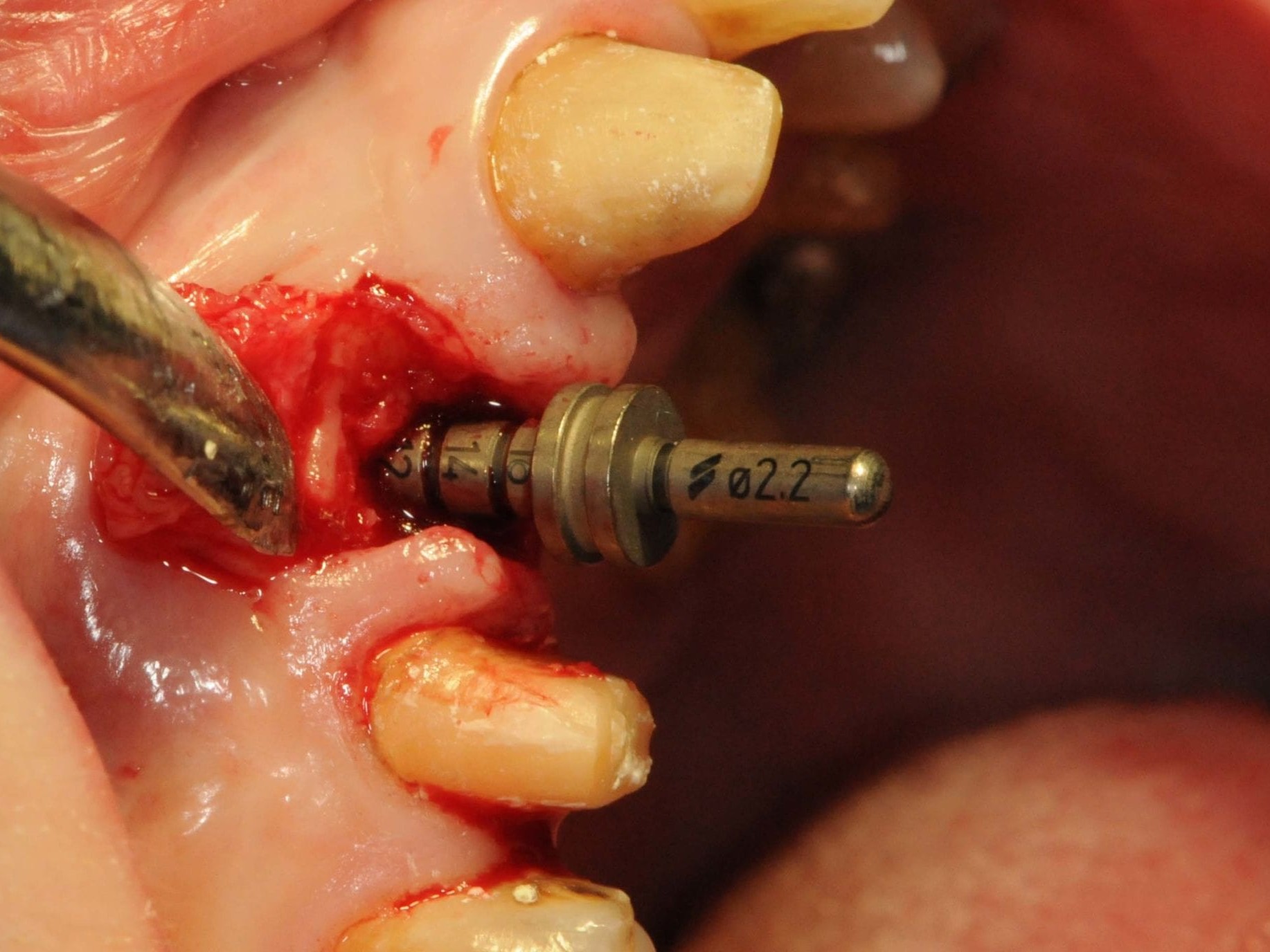 Abb 9 Überprüfung der Implantatachse nach der Pilotbohrung