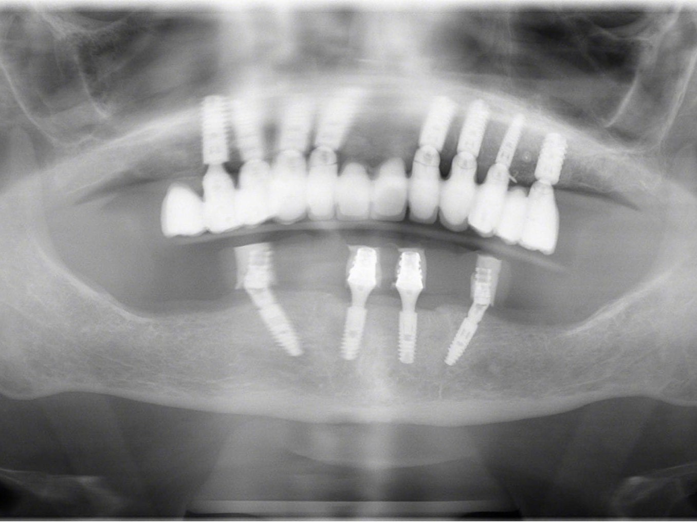 Abb. 1 Postoperatives Orthopantomogramm