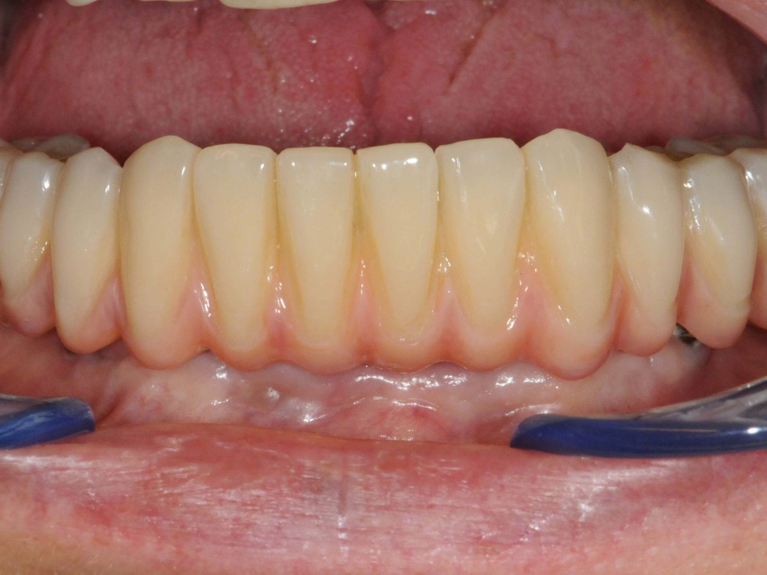 Abb. 9a vestibuläre Ansicht in situ