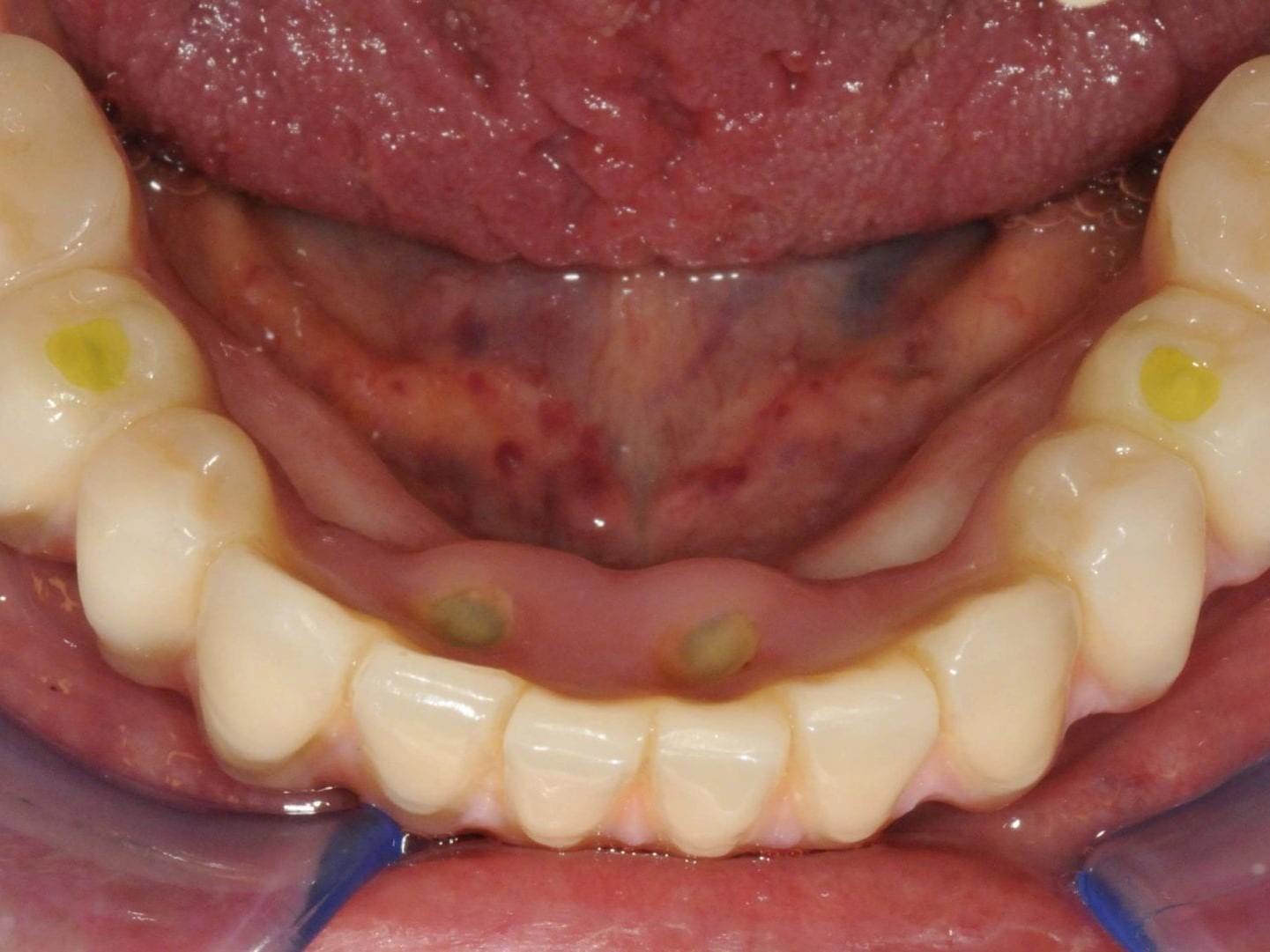 Abb. 9b okklusale Ansicht in situ
