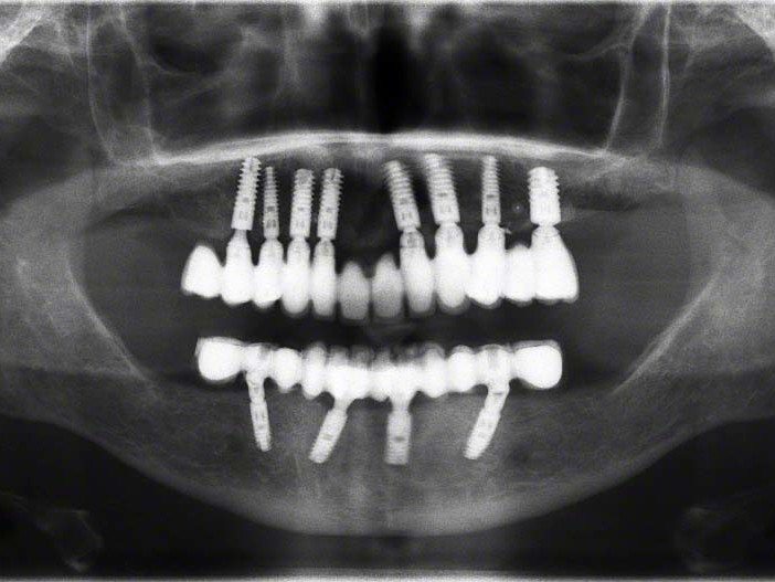 Abb. 10 OPG mit eingegliederter Prothetik