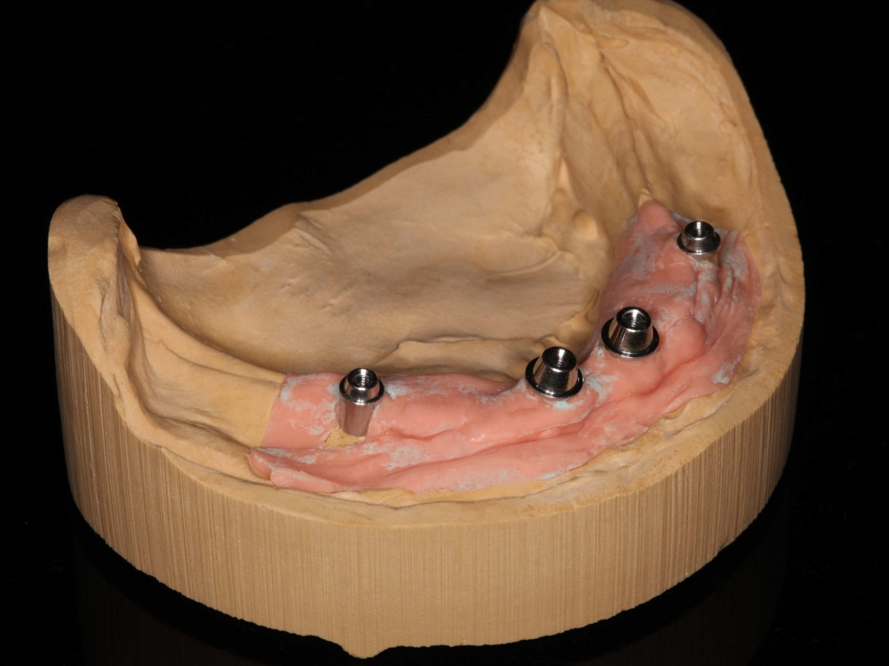 Abb. 2 Meistermodell mit typischer gingivamaske