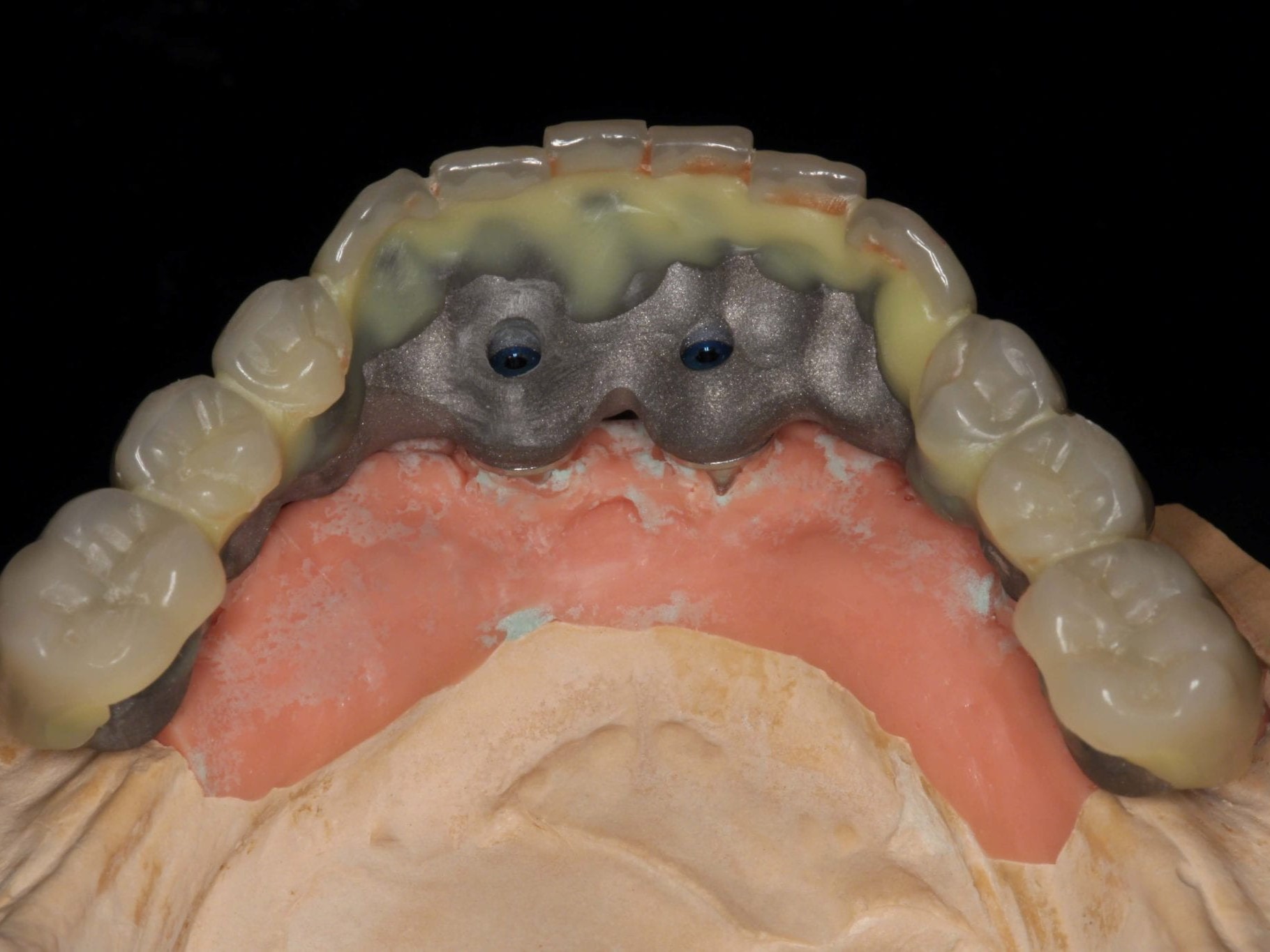 Abb. 6 Aufstellung der Unterkieferzähne