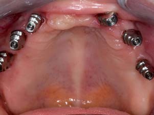 Abformpfosten für die geschlossene und indexierte Abformung im Oberkiefer …