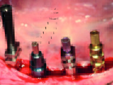 Abformpfosten in situ