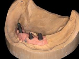 Abgestrahlte individuelle ATLANTIS-Abutments für den Unterkiefer