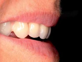 Abschließende Ästhetikeinprobe