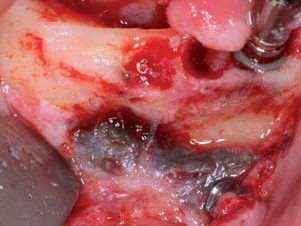 Amalgamablagerungen der alten WSR in der Unterkieferfront