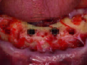 Ankylos® C_X –A-Implantate in situ