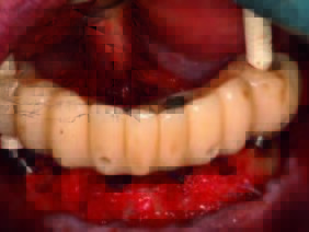 Anpassung des virtuell geplanten Interimszahnersatzes