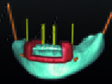 Ausgangssituation des krestalen Knochengrades