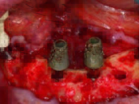 Ausrichtung der angulierten Ankylos Balance Basisaufbau