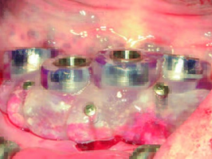 Bohrschablone in situ mit Osteosyntheseschrauben fixiert