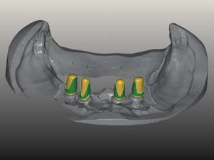 Design der Patrizen mit der CAD-Software
