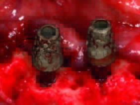 Die Implantate in regio 032 und 042 mit Ankylos Balance Basisaufbau