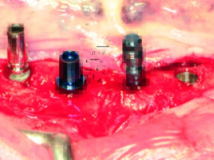 Die vier verschiedenen Implantate in situ mit bzw. ohne ihre industriell vorgegebenen Einbringhilfen