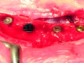 Die vier verschiedenen Implantate in situ mit ihren jeweiligen Verschlusskappen