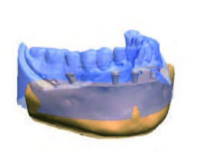Digital Immediate Smile Model mit gemachtem Situationsscan
