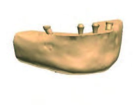 Digital Immediate Smile auf Abutmentniveau